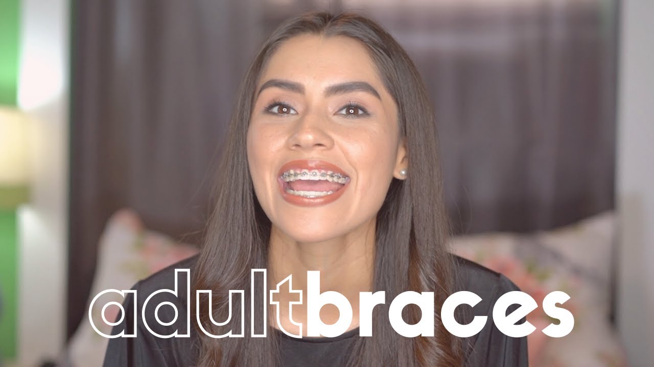 Why I got Adult Braces in my 20s