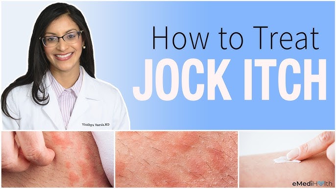 Jock Itch: Symptoms, Treatment, Prevention