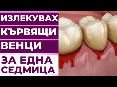 Видео: Как да се отървете от гингивит: 12 ефективни начина за спиране на болестта на венците