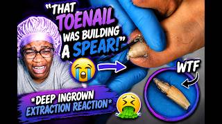 🔥 “That Toenail Was Building a SPEAR!” 😭🦶 Ingrown Toenail Extraction Reaction #Gross