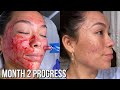 Microneedling Session Month 2 Results + Progress