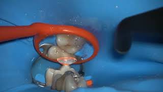 видео: Лечение контактного кариеса 26 зуба картинка: Лечение контактного кариеса 26 зуба