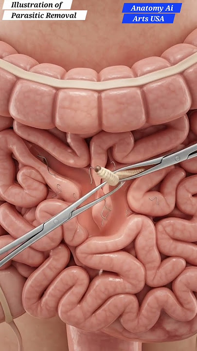 Illustration of Gut Organism Removal | Realistic AI Art | Gut Health | Anatomy AI Arts USA |