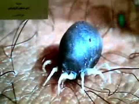 تصوير شخص الزهراني قراد ياغذى على دم الانسان WMV V9