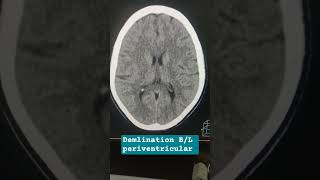 Short Focus In Bilateral In High Partial White Matter Possibility -Demalination.