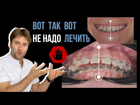 Чем может закончиться неправильное лечение на брекетах?