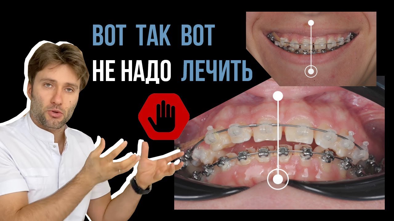 Чем может закончиться неправильное лечение на брекетах?