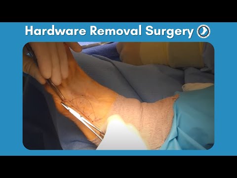 Hardware Removal Surgery