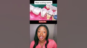 Deep cleaning at the dentist #shorts #teethcleaning #deepcleaning