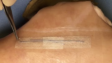 SUTURE REMOVAL - SUBCUT