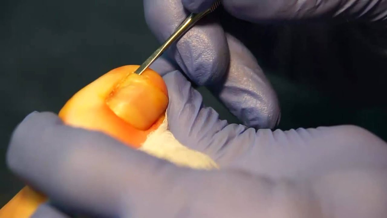 Ingrown Toenail Removal Surgery YouTube
