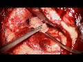 Pterional Craniotomy for Resection of a Giant Clinoidal and Cavernous Sinus Meningioma