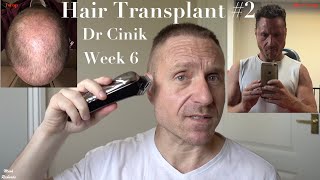 Hair Transplant Number 2, Week 6 Results, Shaving Donor Area! Dr Cinik, Istanbul, Turkey. Hairloss.