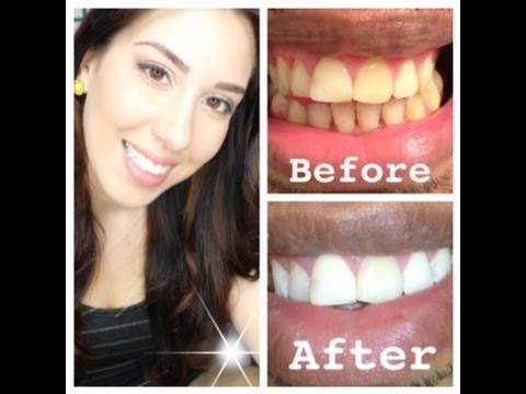 How do you whiten your teeth super fast?
