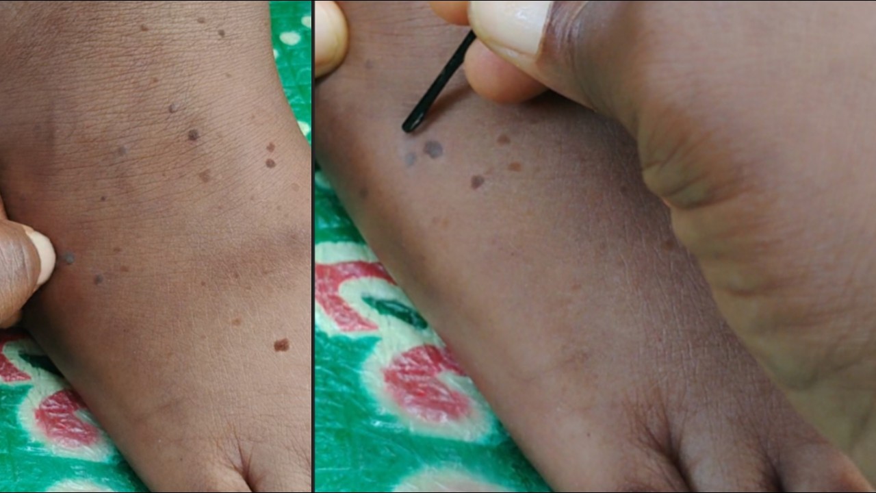 Compound Skin Tag Skin Tag Examination ASMR | Close-Up Relaxing Sounds - YouTube