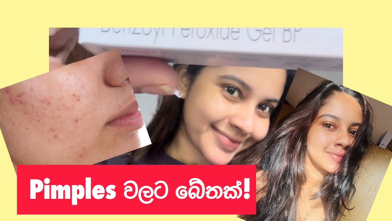 Pimples වලට මං කියනවා කිව්ව බෙහෙත!