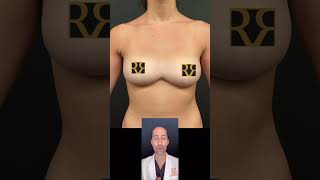 ✨ Dr. Repta Answers: Symmastia Repair Without Mesh ✨