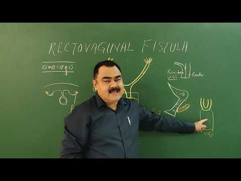 Rectovaginal fistula by Dr A K Singh