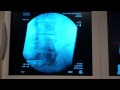 Radio Frequency Ablation Demonstration