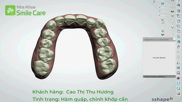 VIDEO 3SHAPE KHÁCH HÀNG THU HƯƠNG - NIỀNG TRONG SUỐT SMILESALIGN