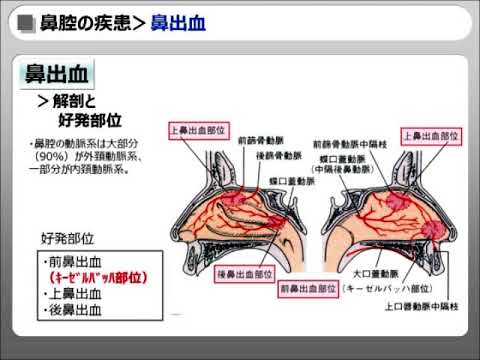 鼻出血（藤田医大耳鼻咽喉科教材）