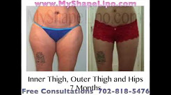 Thighs Liposuction, Inner Thigh, Outer Thigh, Full Thigh; Before and After, MyShape Lipo