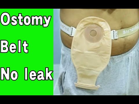 Stop Ostomy leak tool, how stop ostomy leakage - YouTube