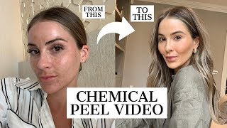 CHEMICAL PEEL | HOW I HEALED MY PIGMENTATION | NADIA ANYA