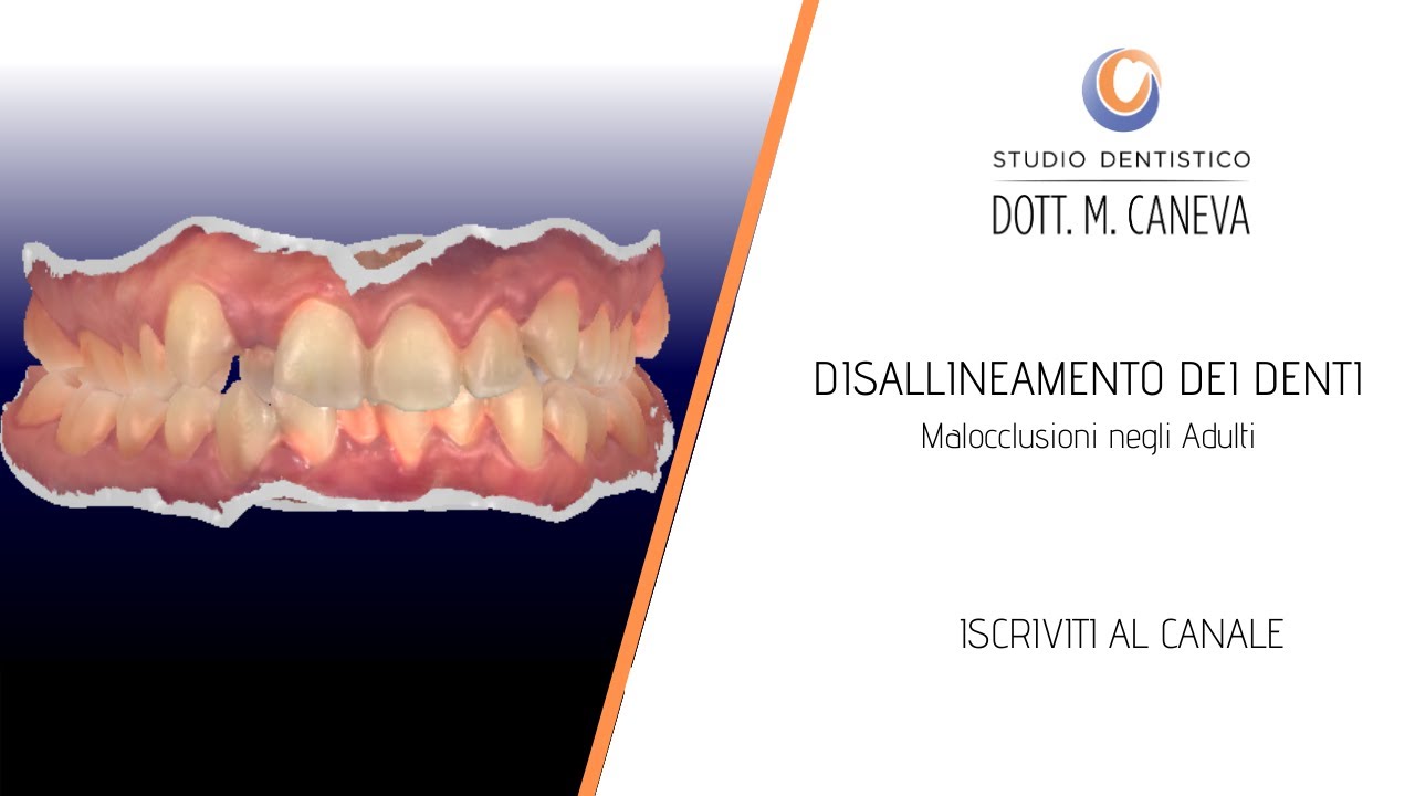 DISALLINEAMENTO dei DENTI - Malocclusioni negli Adulti | Studio Dentistico Dott. M. Caneva