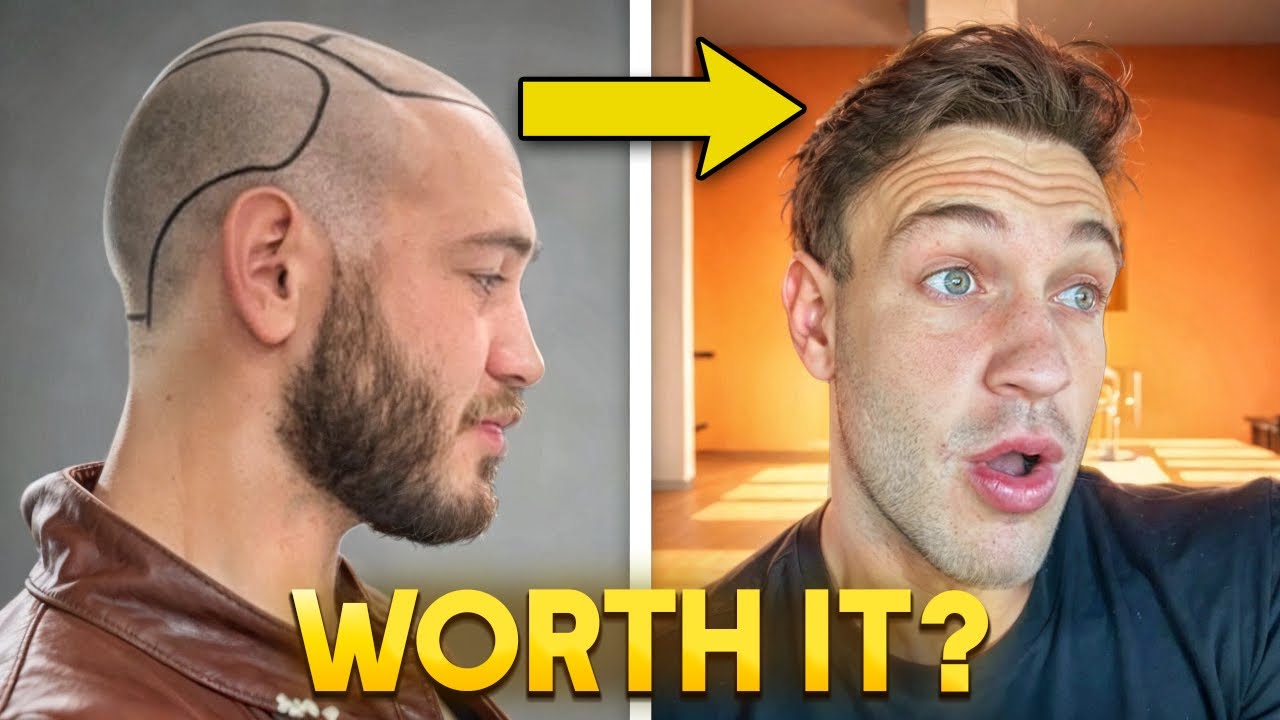 1 YEAR POST HAIR TRANSPLANT UPDATE ( Was it worth it? )