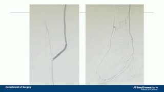 CVI 2019_Saturday, 7/20_ Master’s Approach to Critical Limb Ischemia II_Bala Ramanan, MBBS, MS