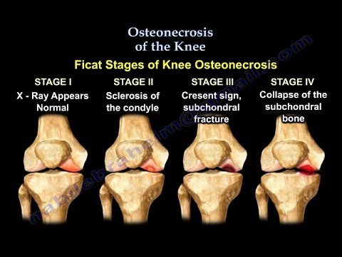 Videó: A Neutrofil Granulocita Szintek és A Combcsont Fejének Osteonecrosisának összefüggései