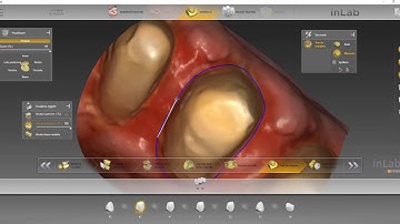 7 units lower restoration - Incisal bridge - Inlab 18.1 by Dentsply Sirona