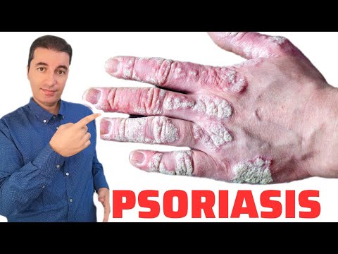 Video: Njia 3 za Kuelezea Tofauti kati ya Eczema na Psoriasis