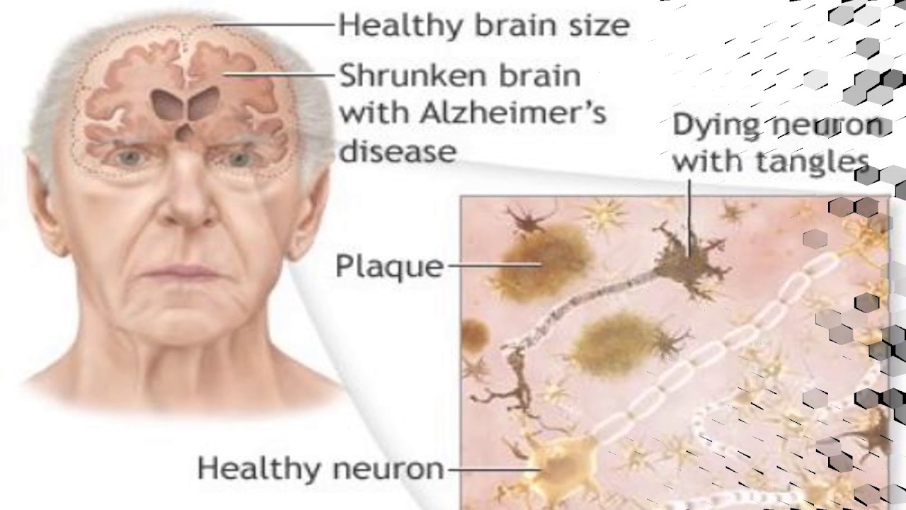 Атрофия мозга у взрослого. Деменция альцгеймеровского типа. Отмирание клеток головного мозга. Симптомы отмирания клеток мозга.