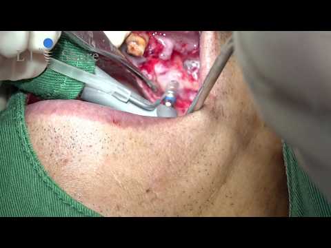 Video: Cyst I Maxillary Sinus: Orsaker, Behandling, Dimensioner Att Ta Bort, Symtom