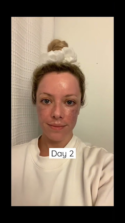 MY 20% TCA PEEL TRANSFORMATION - DAY 1 THROUGH HEALED RESULTS!