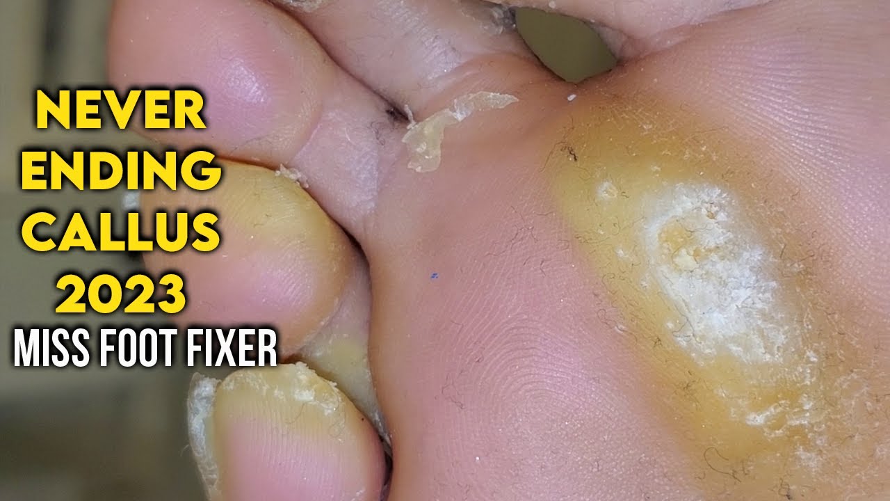 This Foot Callus Removal  Channel Is Equally Disgusting and  Satisfying to Watch