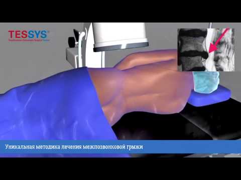 Video: Эндоскопиялык операциябы?