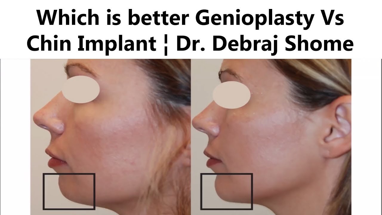 Pros & Cons of Genioplasty & Chin Implants The Esthetic Clinics