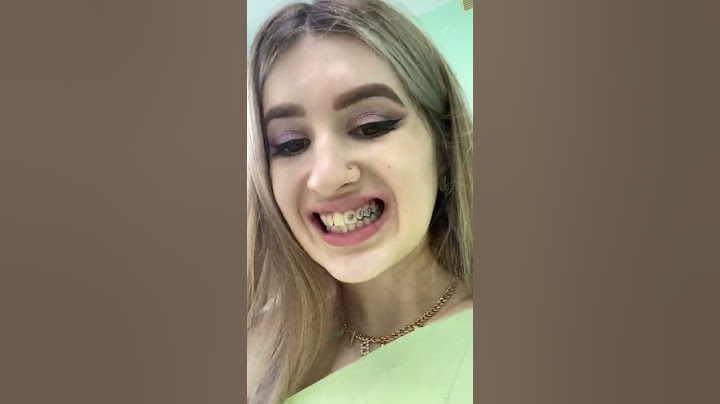 Снова брекеты 😣