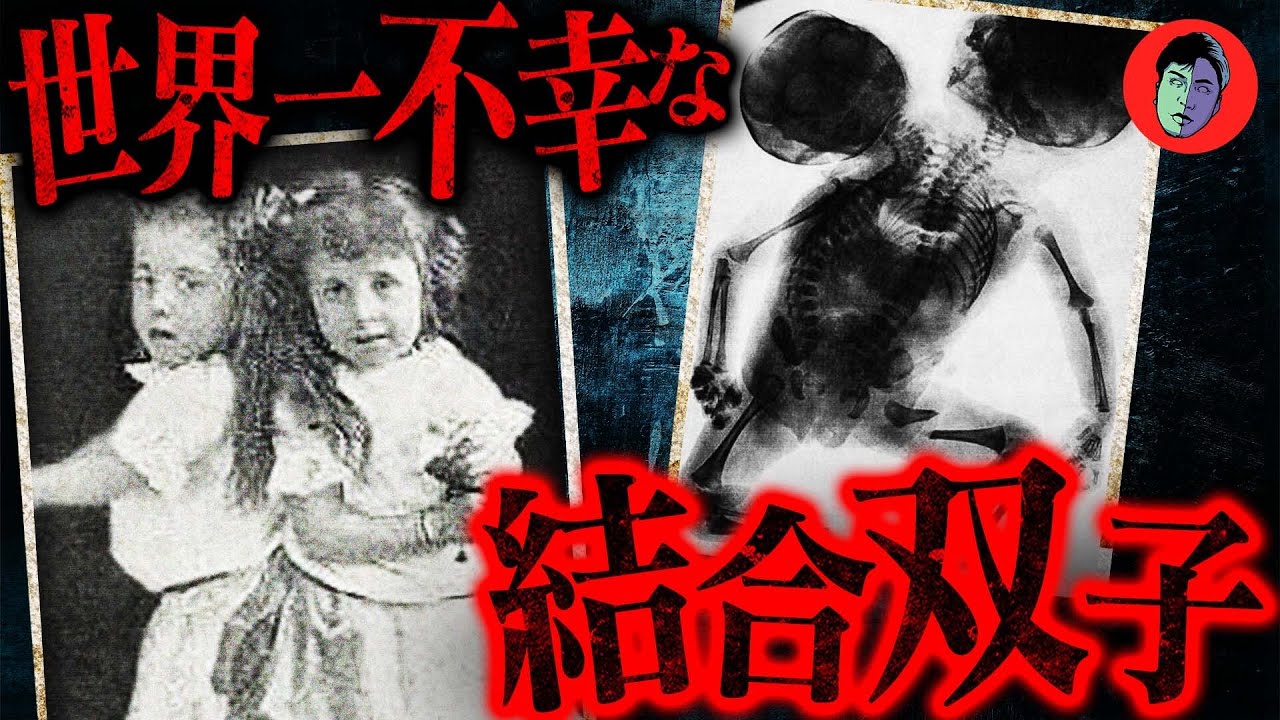 【実話】世界一不幸な双子…搾取され続けた人生