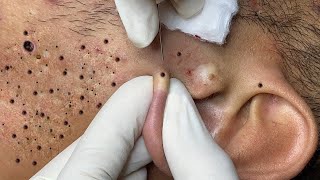Make your day Relax with Relaxing LNS / blackheads removal/ blackheads animation blackheadsremoval