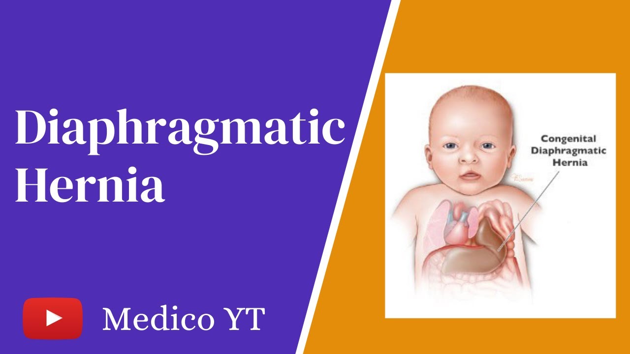 Diaphragmatic Hernia Signs and Symptoms Diagnosis Management