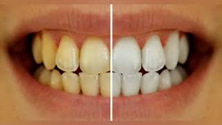 تبييض الاسنان في ثواني،تزيل اصفرار الاسنان،وتسقط الجير،Removing yellowing and whitening teeth