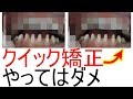 クイック矯正(セラミック矯正)のデメリット。後悔するから止めとけ