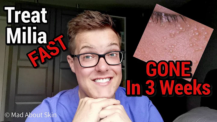 How To Get Rid Of Milia (FAST) - White Spots Under The Eyes