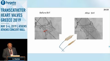S. Prapas  | The selection of SAVR devices in the TAVR era