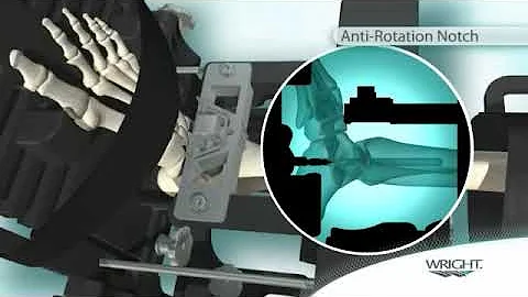INBONE II Total Ankle Replacement