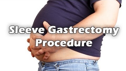 Sleeve Gastrectomy Procedure Animation